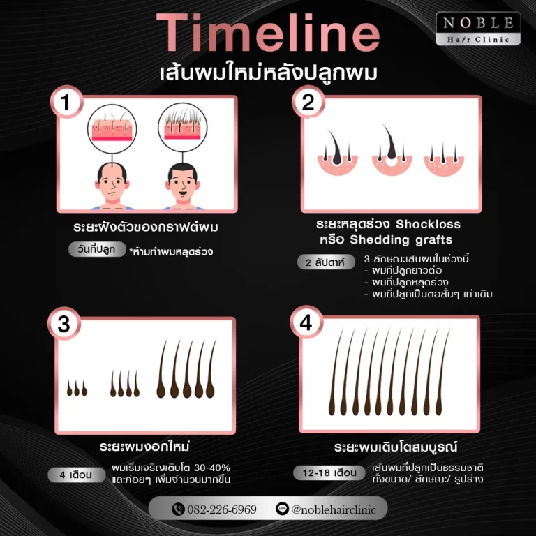 ปลูกผม FUE อินโฟกราฟิก Noble Hair Clinic (9/9)