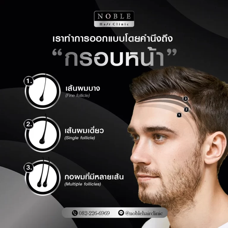ปลูกผม FUE อินโฟกราฟิก Noble Hair Clinic (2/9)