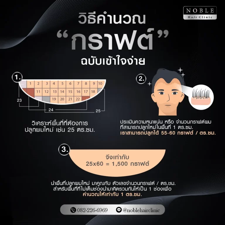 ปลูกผม FUE อินโฟกราฟิก Noble Hair Clinic (3/9)