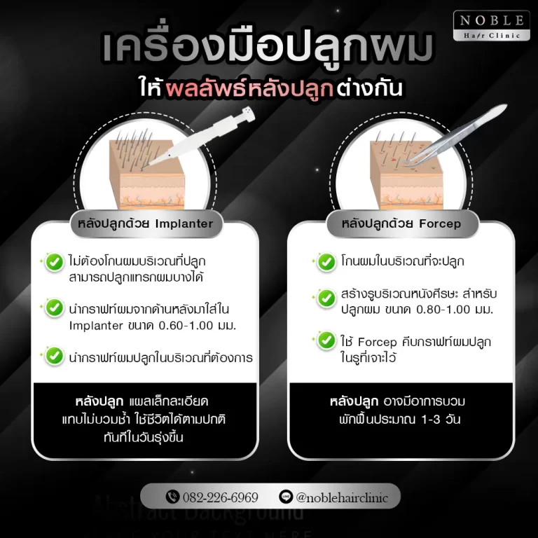 ปลูกผม FUE อินโฟกราฟิก Noble Hair Clinic (4/9)