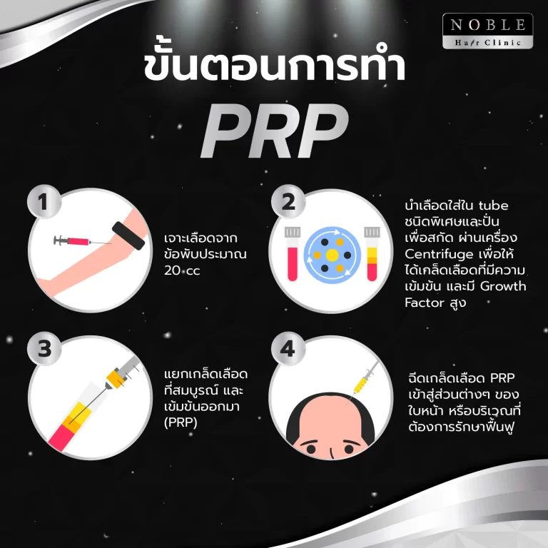 PRP ผม (Platelet Rich Plasma) อินโฟกราฟิก Noble Hair Clinic (8/9)
