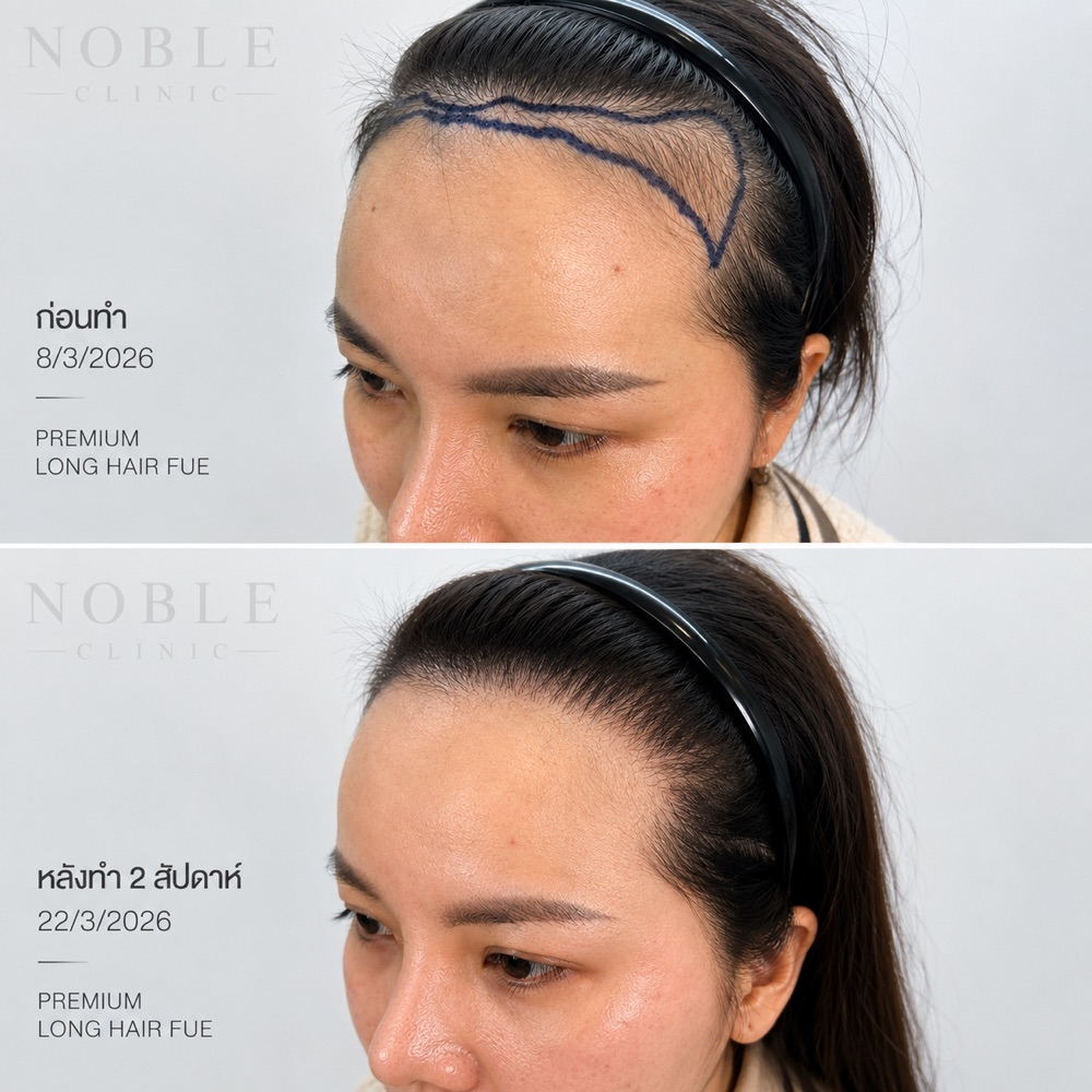 ผลก่อนหลังปลูกผม Premium Long Hair FUE หลังทำ 2 สัปดาห์