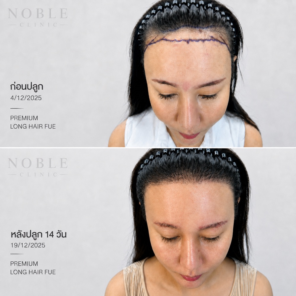 ผลก่อนหลังปลูกผม Premium Long Hair FUE หลังปลูก 14 วัน