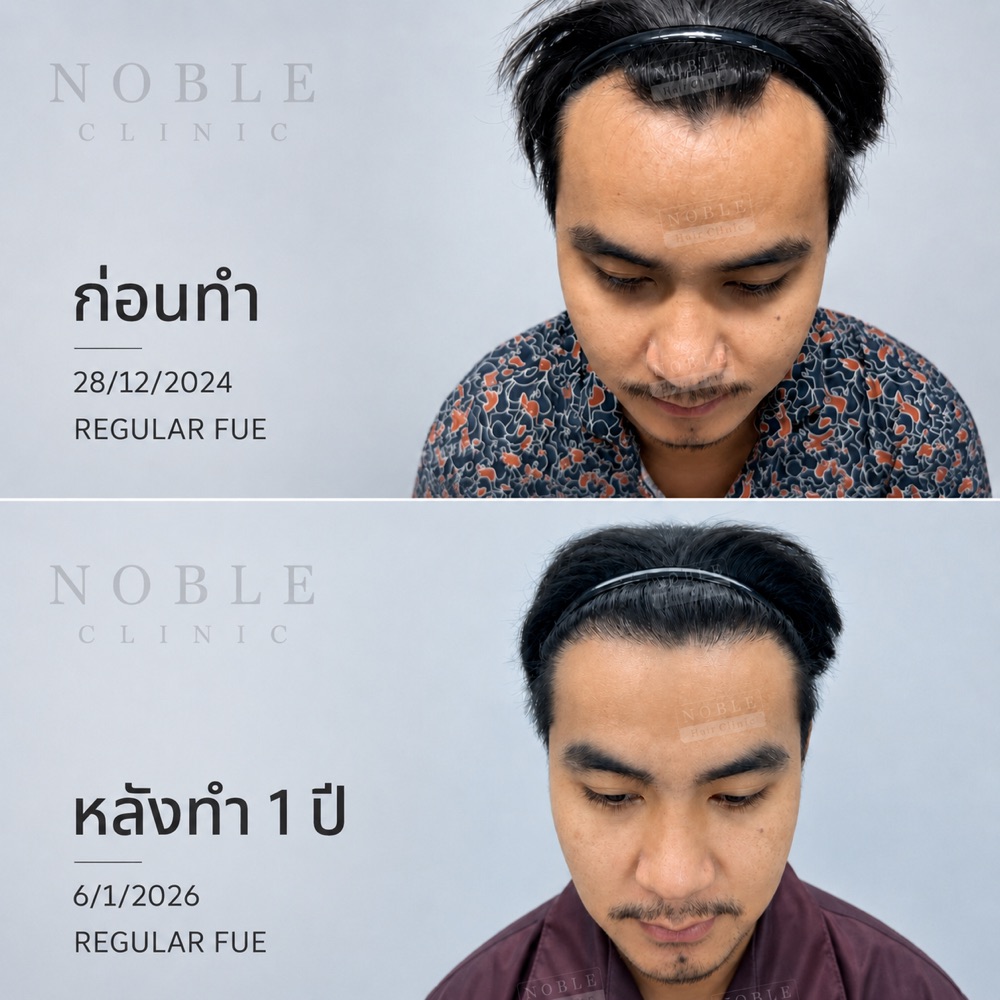 ผลก่อนหลังปลูกผม Regular FUE หลังทำ 1 ปี