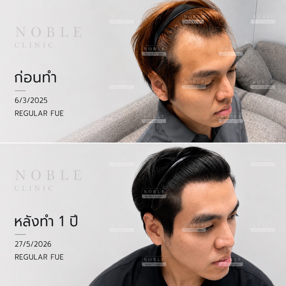 ผลก่อนหลังปลูกผม Regular FUE หลังทำ 1 ปี