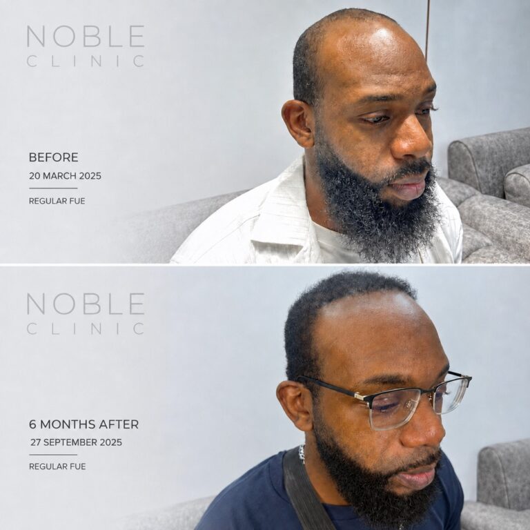 ตัวอย่างผลลัพธ์ปลูกผมก่อนและหลัง 6 เดือน Noble Hair Clinic พัทยา