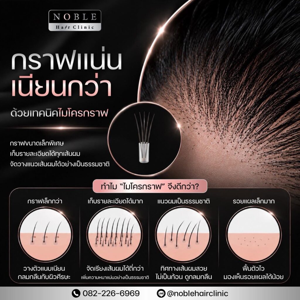 เทคนิคปลูกผม Micrograft กราฟแน่นเนียนกว่า Noble Hair Clinic
